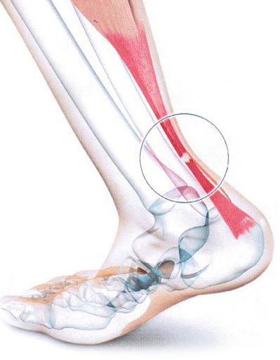 Tendon et Return To Play